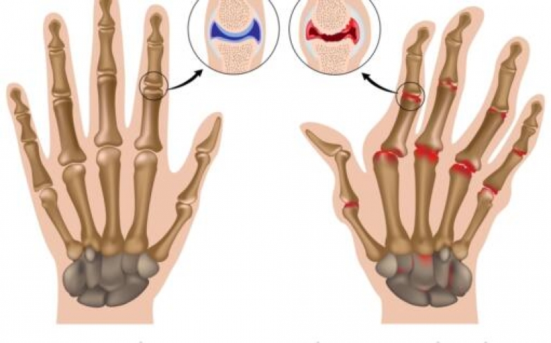 Reumatoidni artritis uništava zglobove, otkrijte ga na vrijeme - hoyttalere-butikk.com